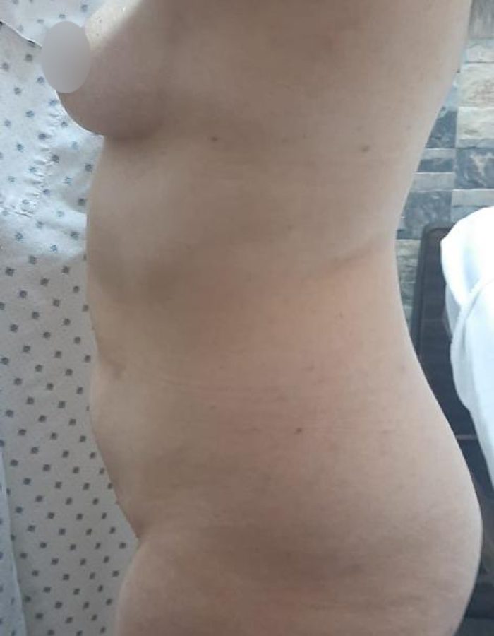 ANTES (2)